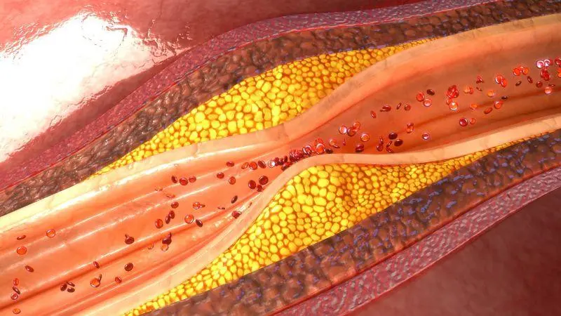 風口 | 冠脈鈣化“終結者”——血管內沖擊波